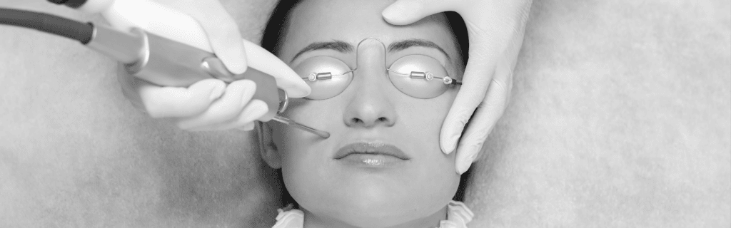 Bilde av Permanent Hårfjerning med Laser og Sprengte blodkar