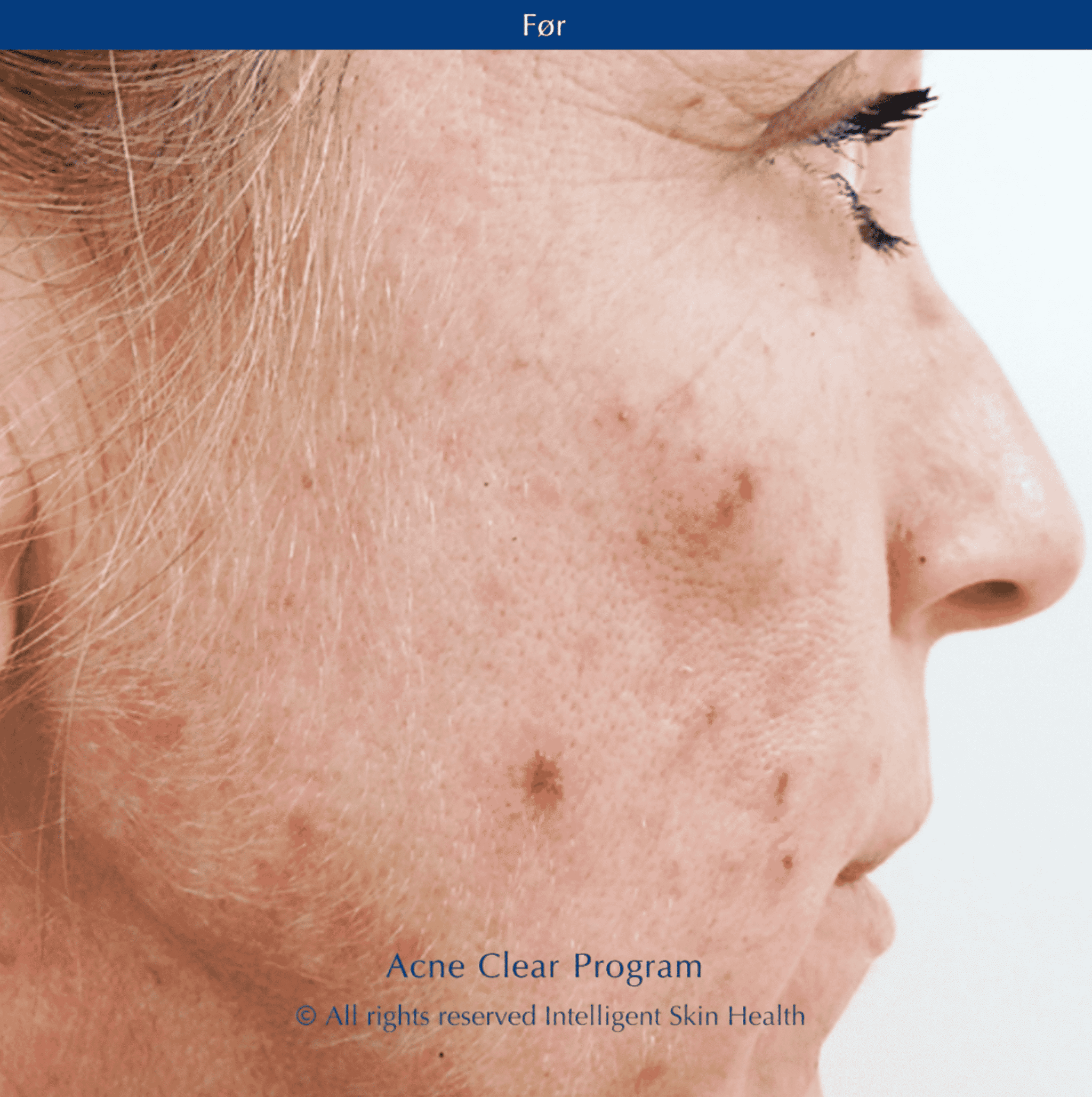 Intelligent Skin Health - Acne Clear Program Before picture