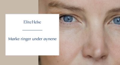 Mørke ringer under øynene – Hvorfor du kan se trøtt ut – selv når du ikke er det