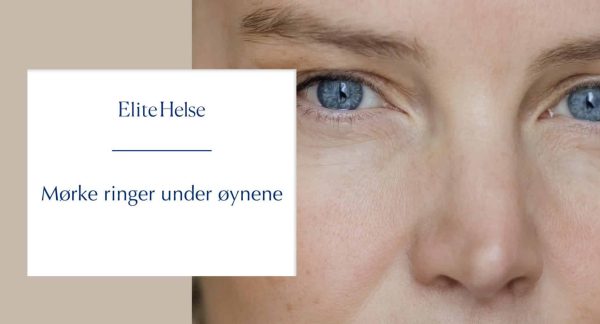 Mørke ringer under øynene – Hvorfor du kan se trøtt ut – selv når du ikke er det