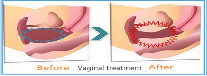 Vaginal Treatment before/after