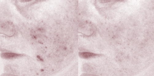 acneClearTreat2 acne Clear Treat 2