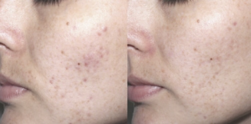 acne Clear Treat picture3