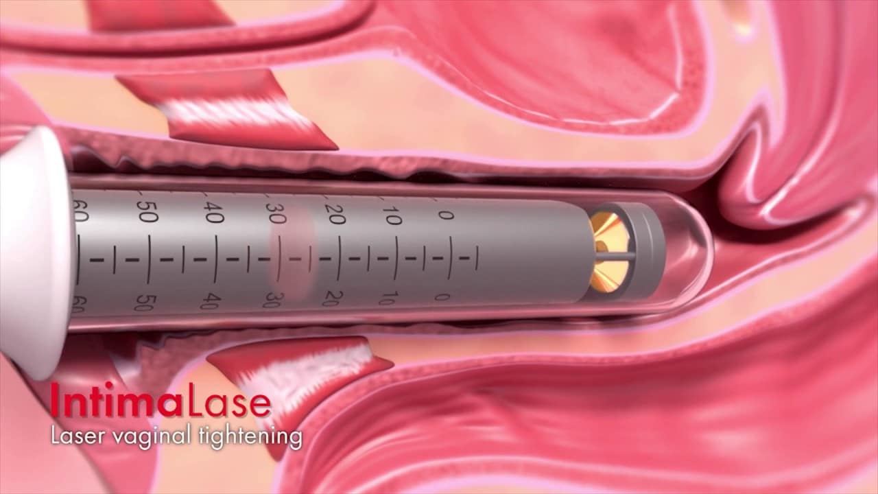 Fotona laserbehandling av fremre vaginalvegg