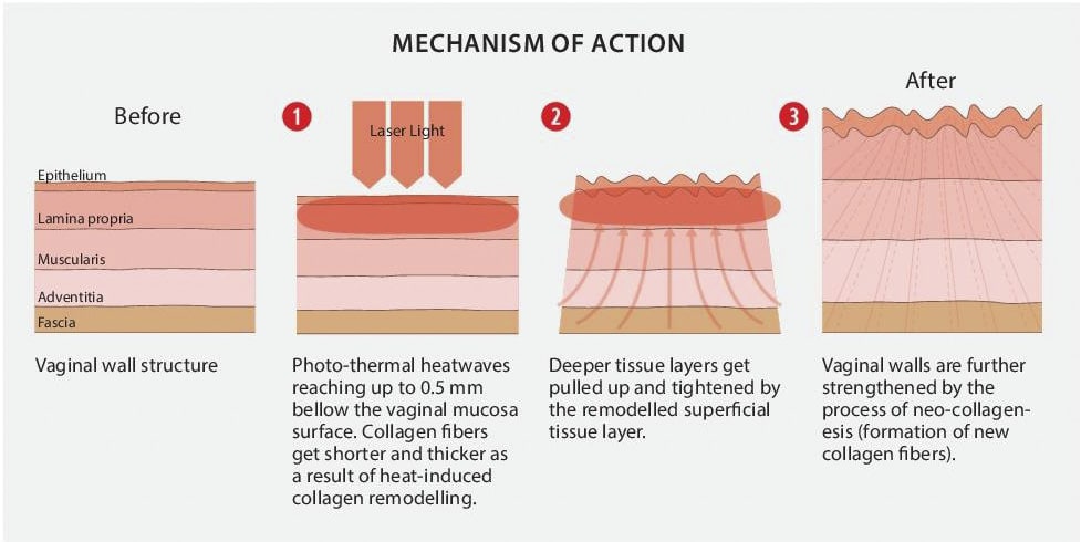 vaginal laserterapi mechanism Action