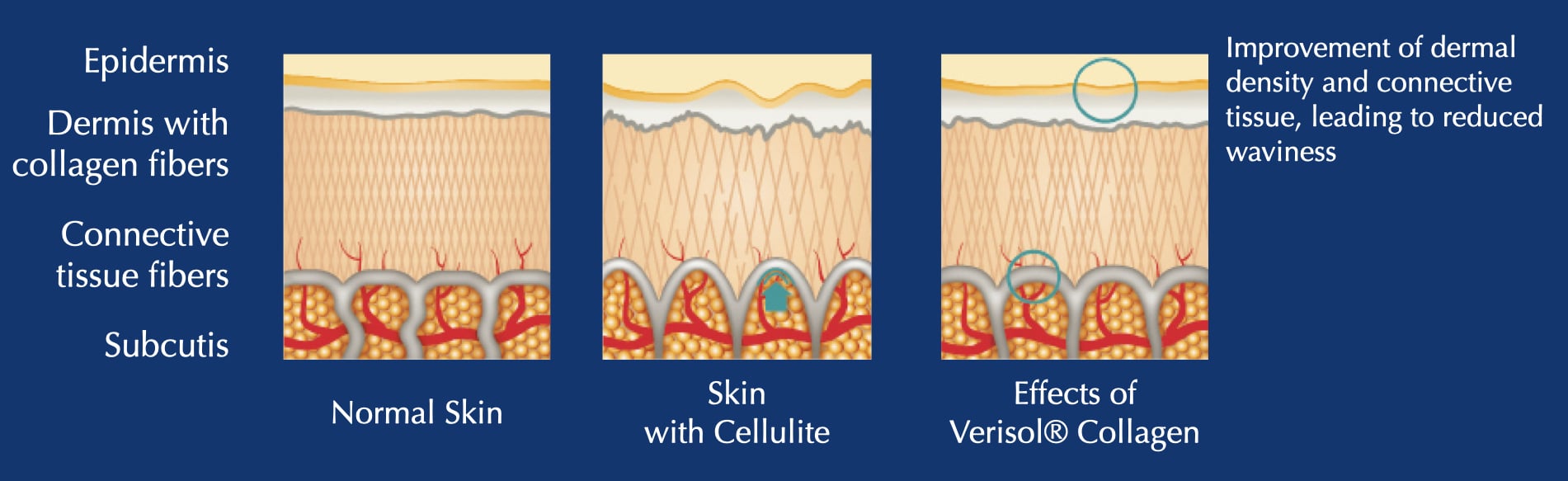 Reduced waviness of the skin surface profile