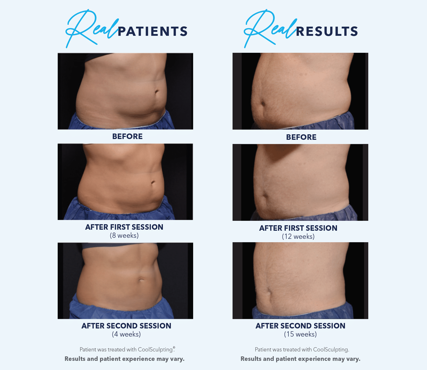 coolsculpting elite real patients real results