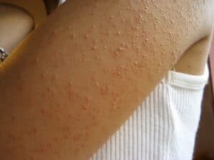 Keratosis pilaris - Hudtilstand