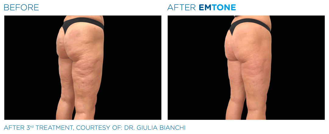 EM Tone - buttock Before / After