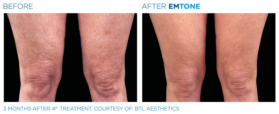 EM Tone - legs Before / After