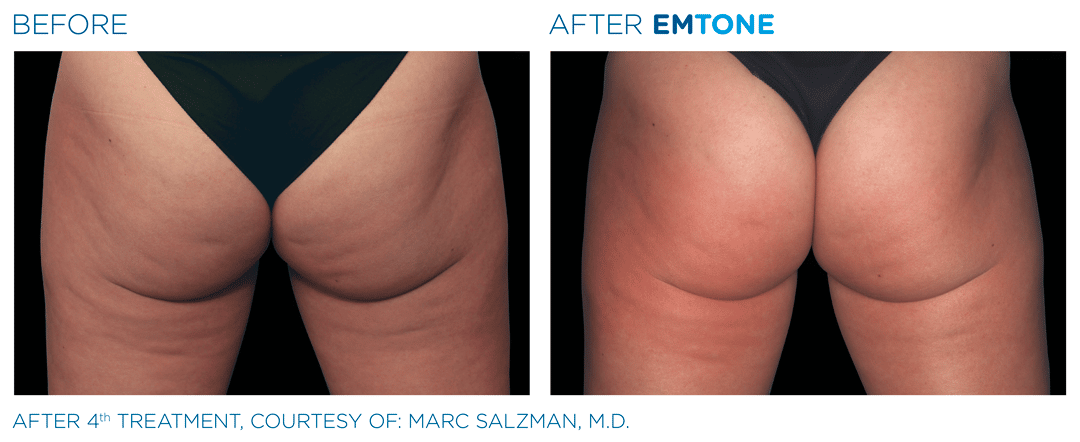EM Tone - buttock Before / After