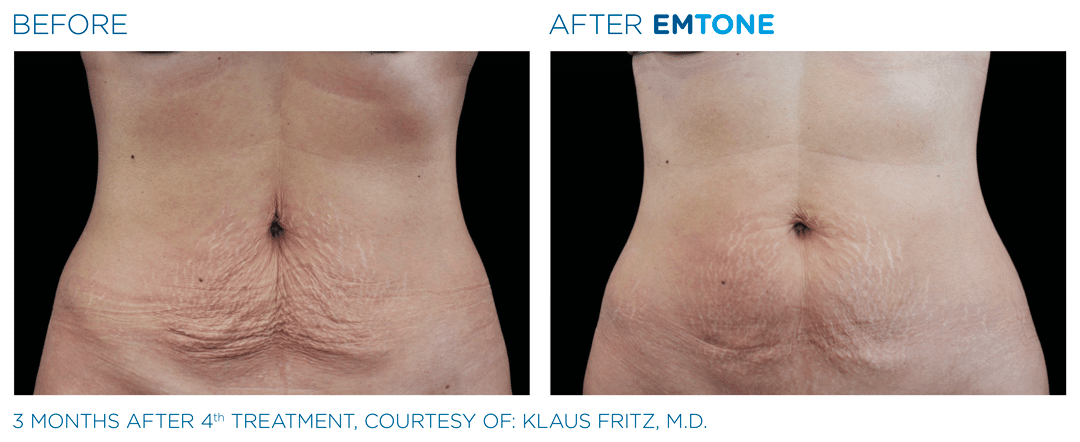 EM Tone - abdomen Before / After