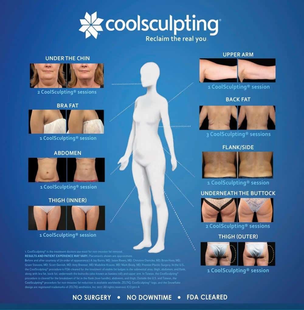 Vanlige CoolSculpting-områder