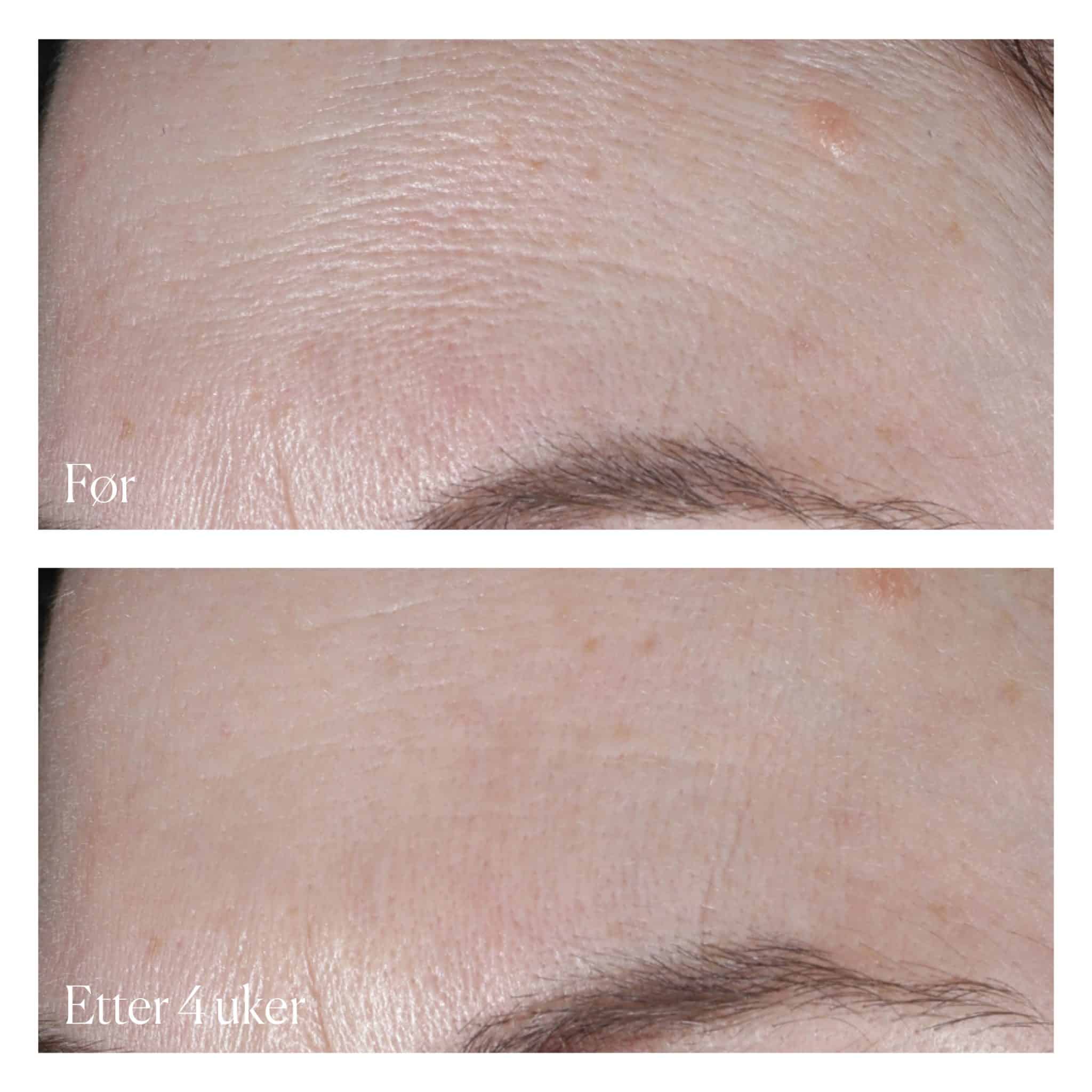 Før / Etter 4 Uker - ProBiGel+ Før / Etter 4 Uker - ProBiGel+