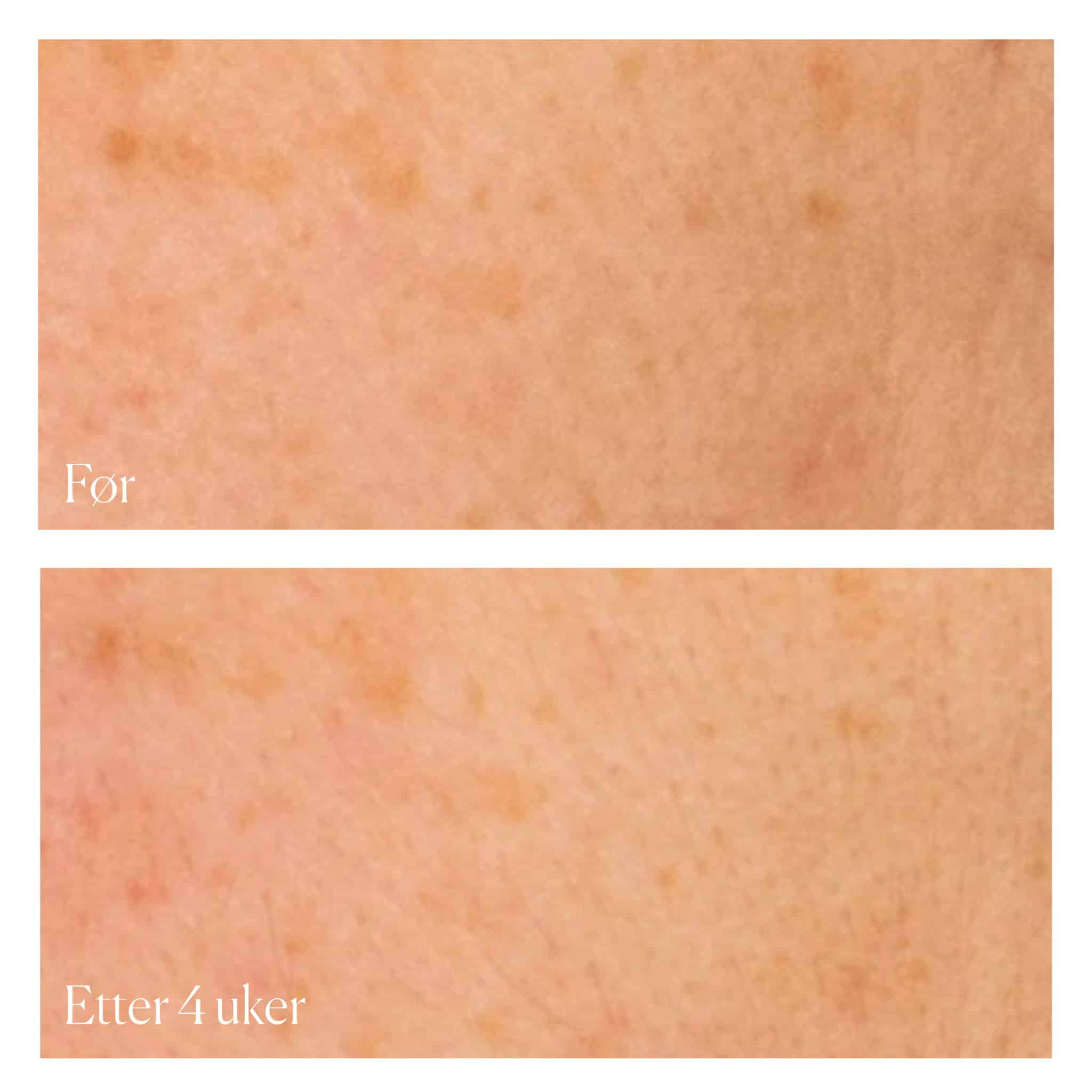Før / Etter 4 Uker-2 Xbiotic Radiance Serum