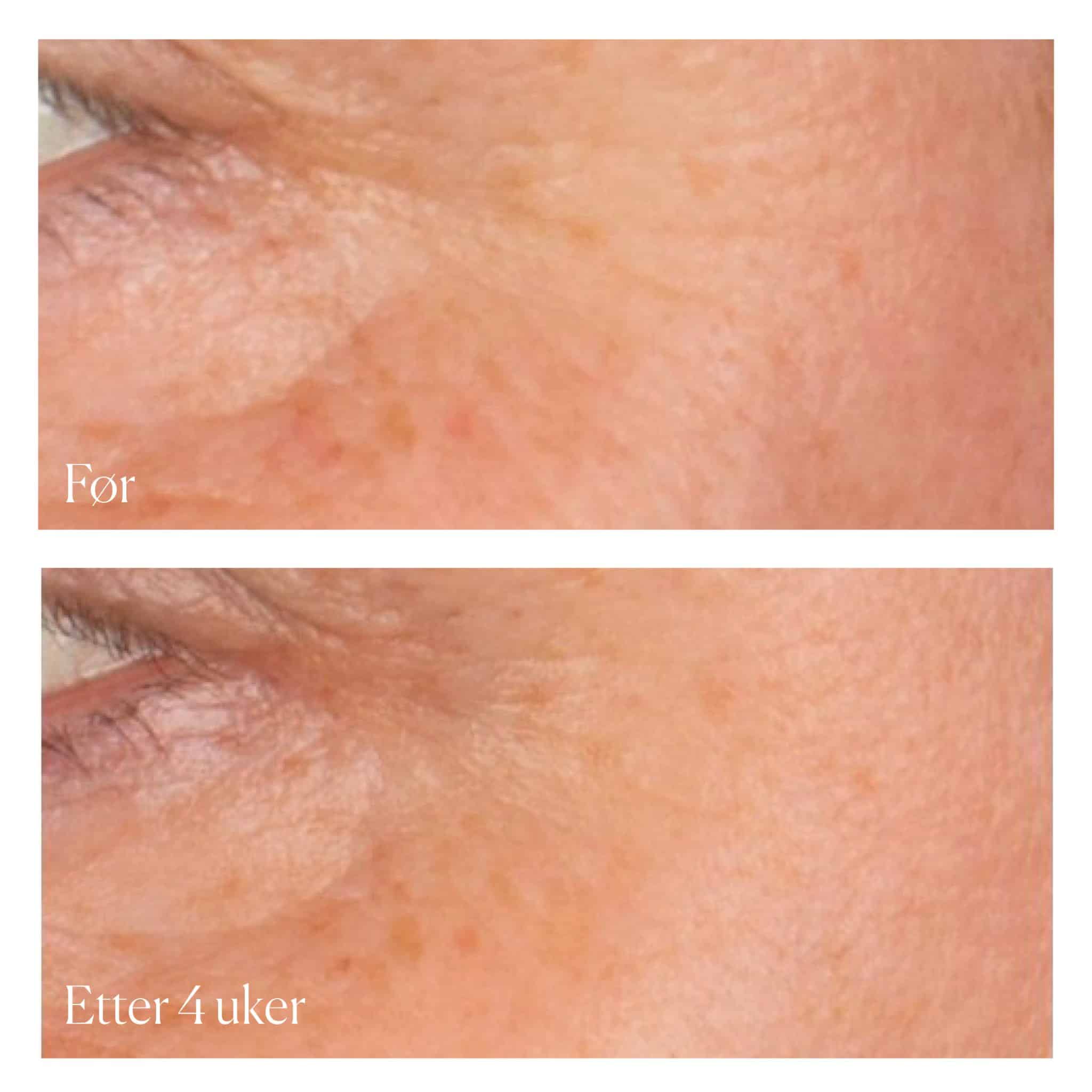 Før / Etter 4 Uker Xbiotic Radiance Serum